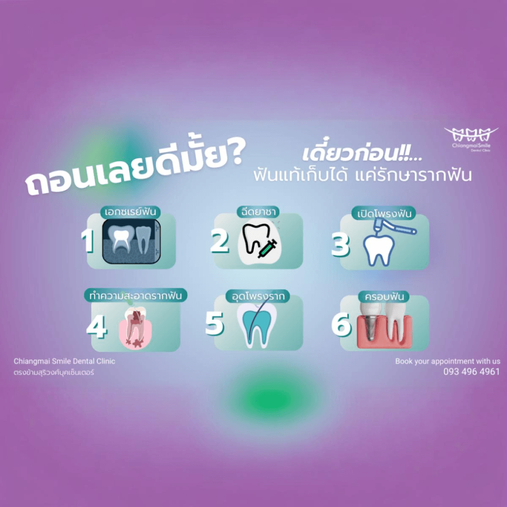 รักษารากฟัน เชียงใหม่