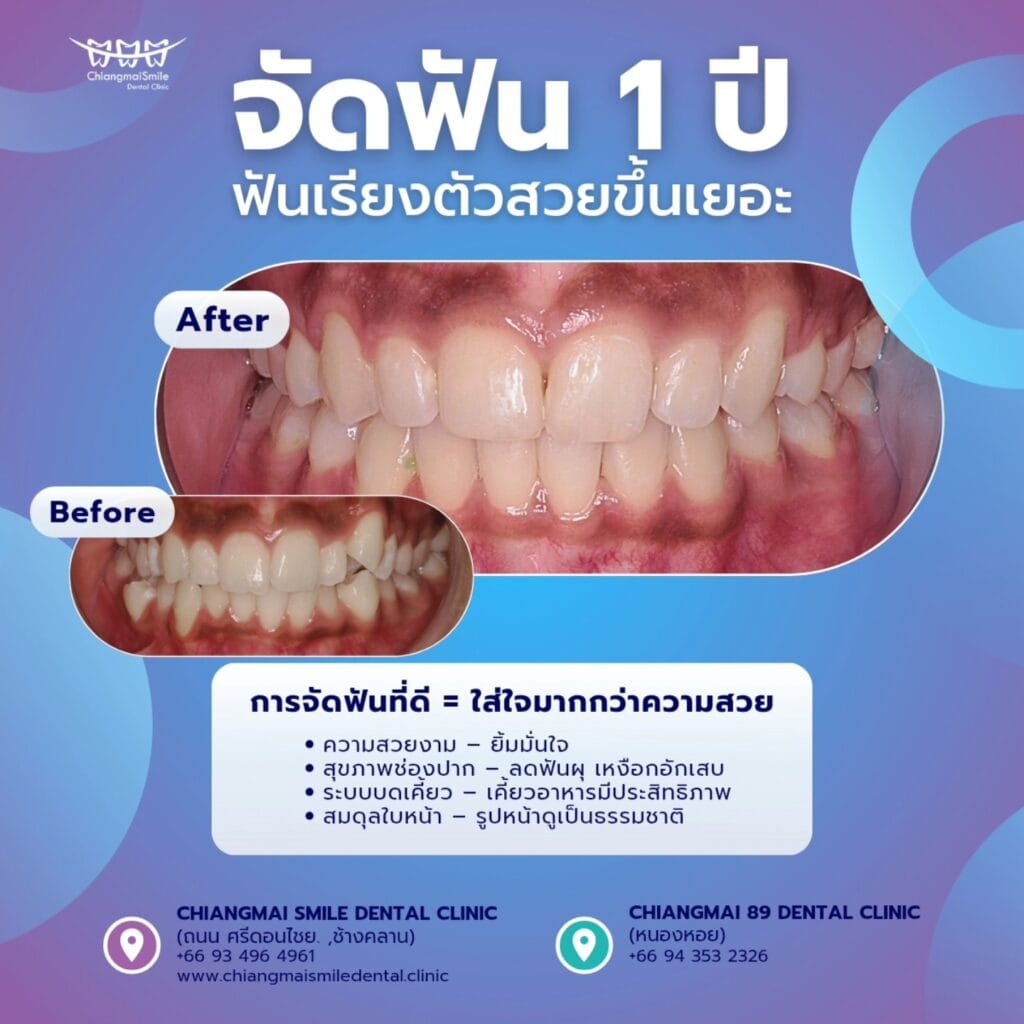 จัดฟัน เชียงใหม่