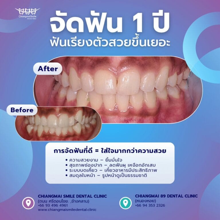 จัดฟัน เชียงใหม่