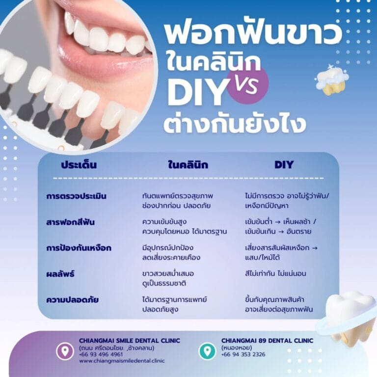 ฟอกฟันขาว เชียงใหม่