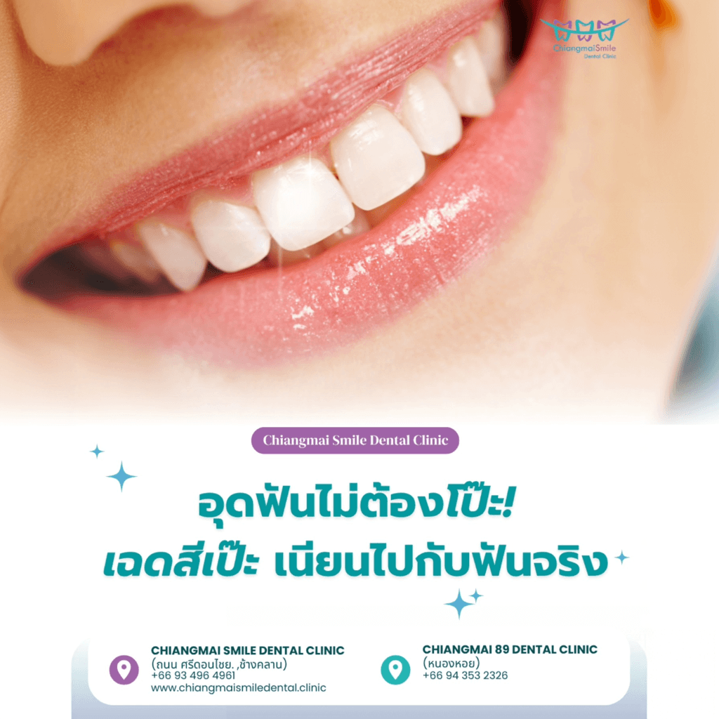 อุดฟันสีเหมือนฟัน เชียงใหม่