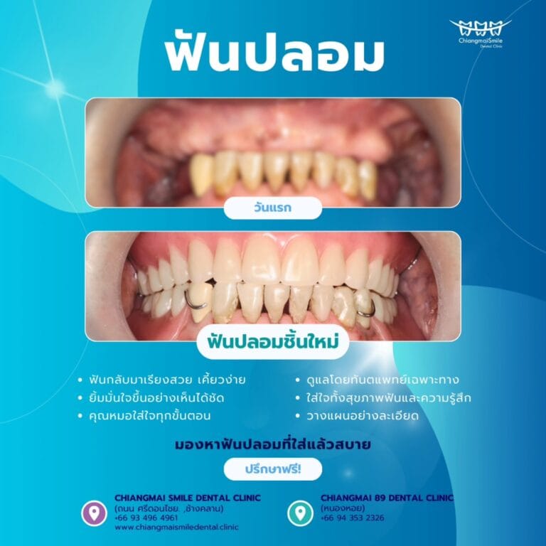 ฟันปลอม เชียงใหม่