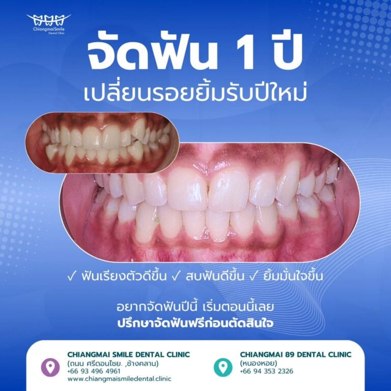 จัดฟัน เชียงใหม่