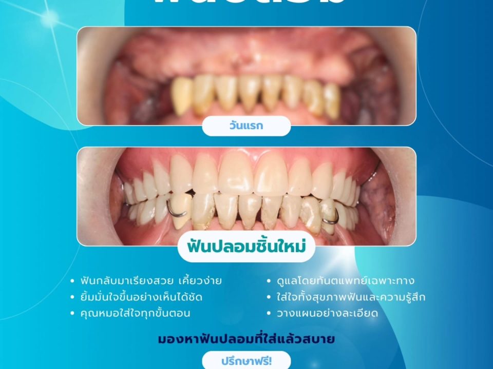 ฟันปลอม เชียงใหม่