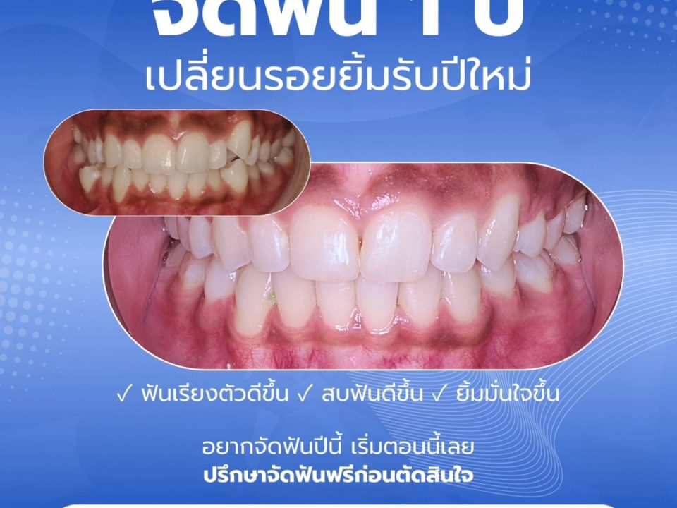 จัดฟัน เชียงใหม่